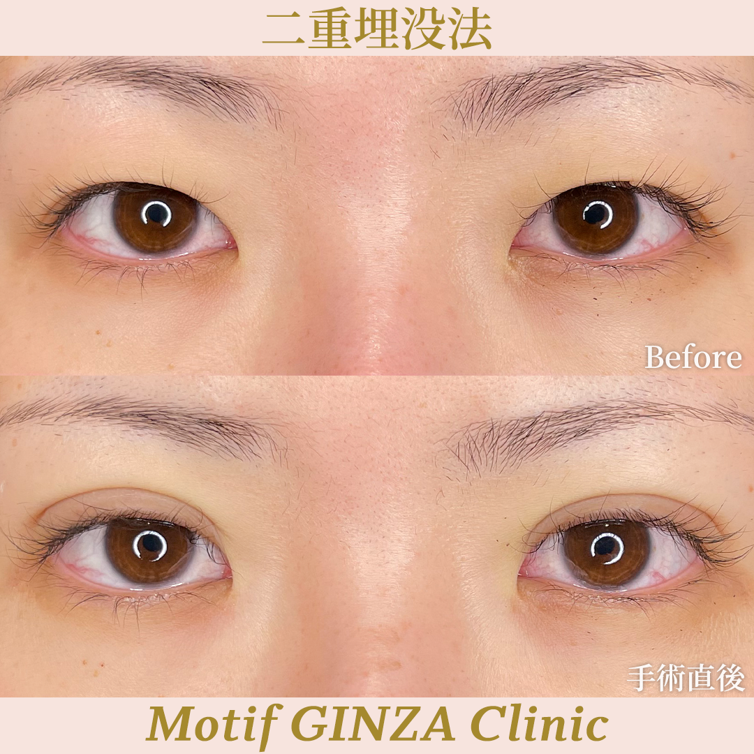 二重埋没法（手術９ヶ月）の写真4