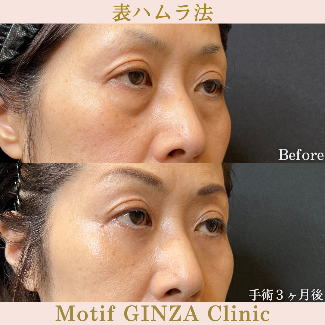 切開式下眼瞼たるみ取り(手術3ヶ月)の写真2