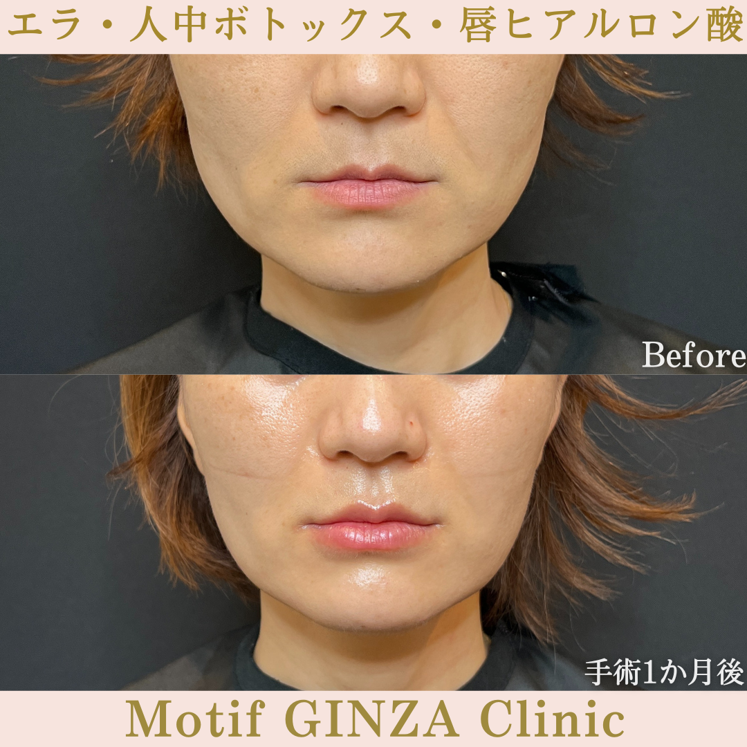 エラ・人中ボトックス・唇ヒアルロン酸（手術１か月）の写真