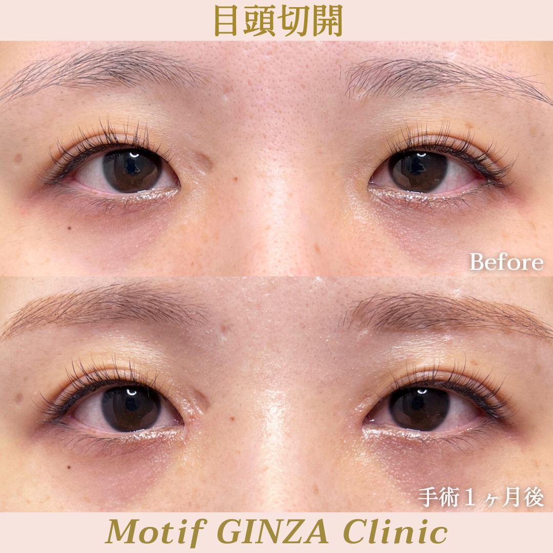 目頭切開手術（手術3ヶ月）の写真2