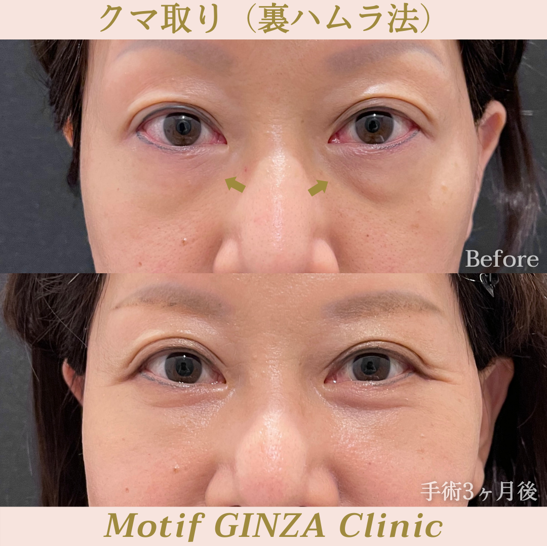 裏ハムラ法(手術3ヶ月)の写真1