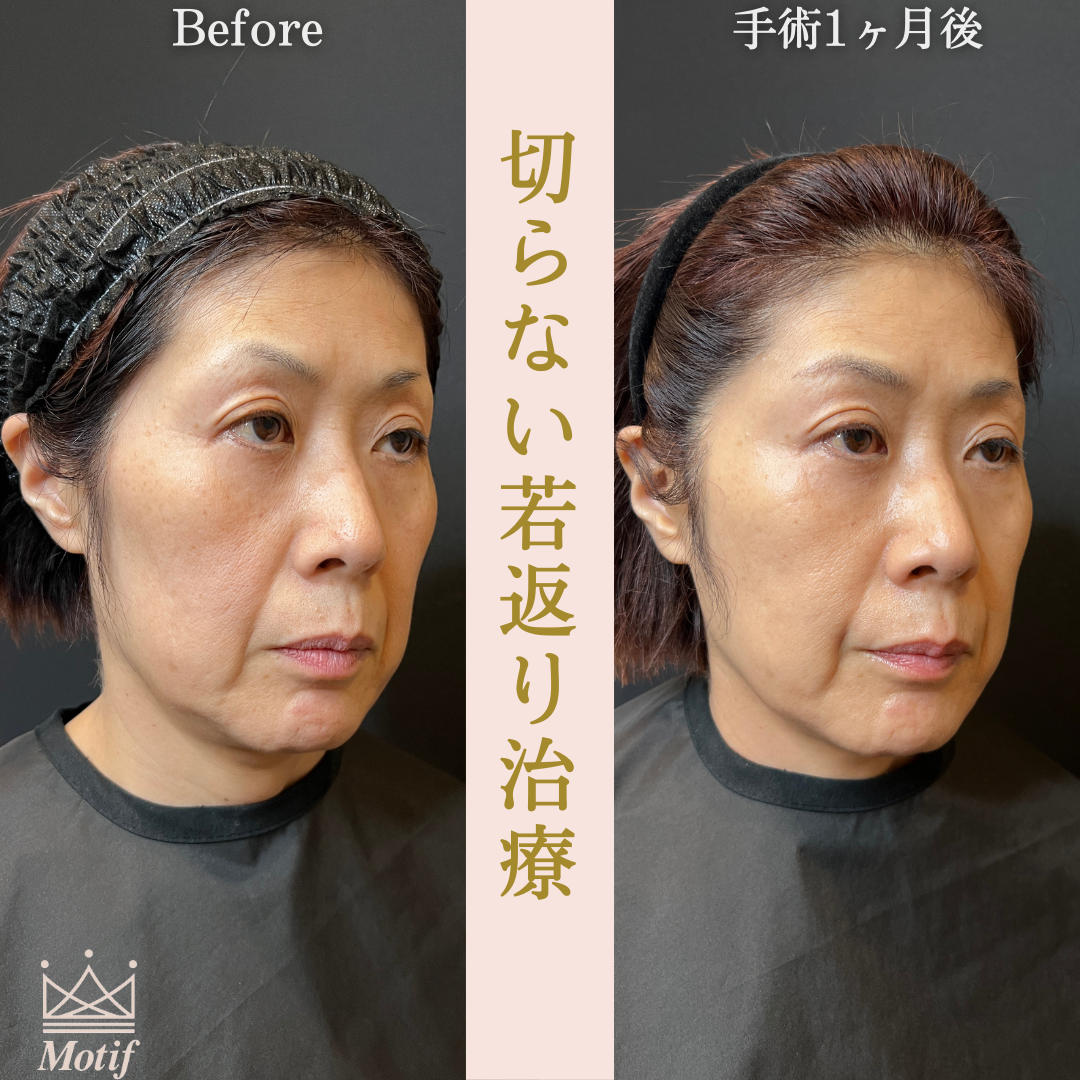切らない若返り治療（手術１ヶ月）の写真
