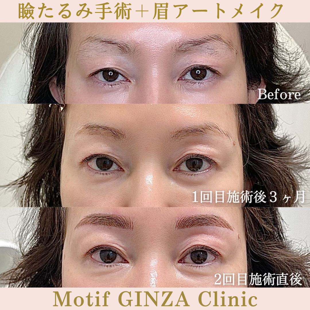 瞼たるみ手術＋眉アートメイク（手術４ヶ月）の写真