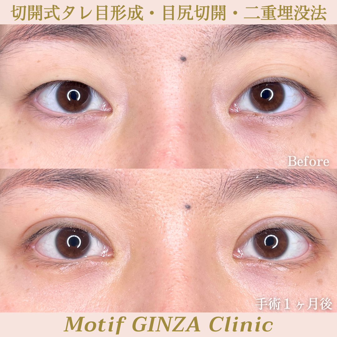 タレ目形成・目尻切開・二重埋没法(手術3ヶ月)の写真4