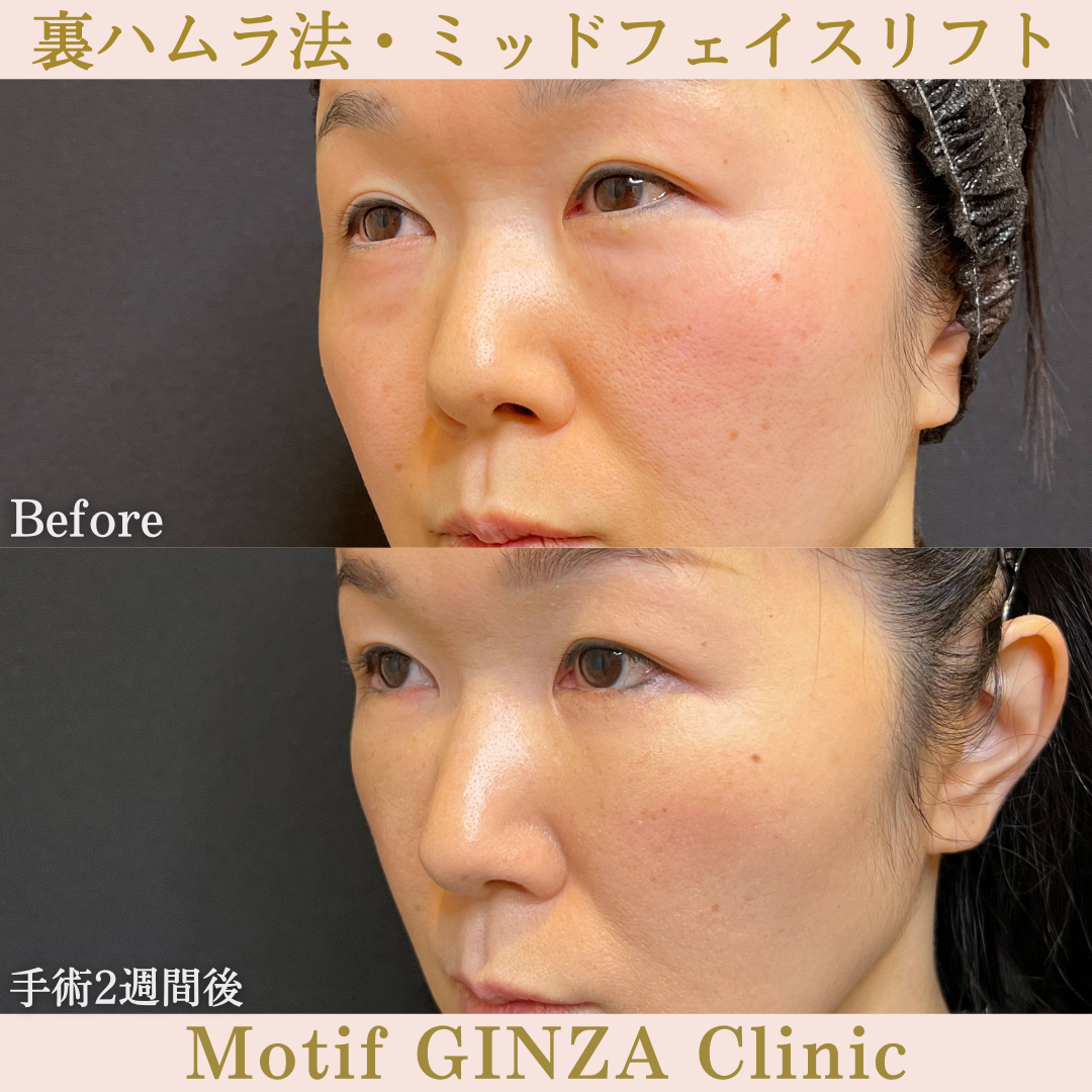 裏ハムラ法・ミッドフェイスリフト(手術6ヶ月)の写真6