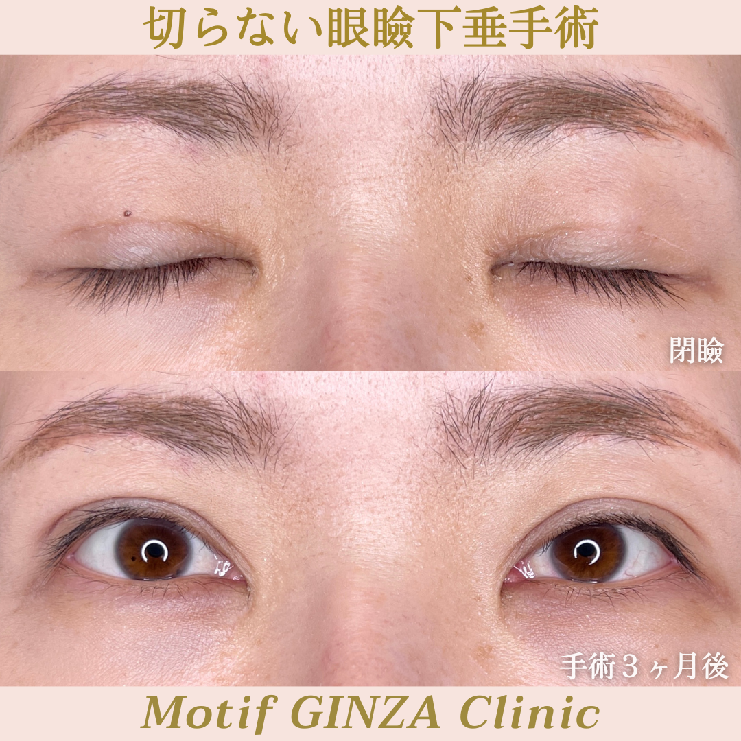 切らない眼瞼下垂手術（手術３ヶ月）の写真2