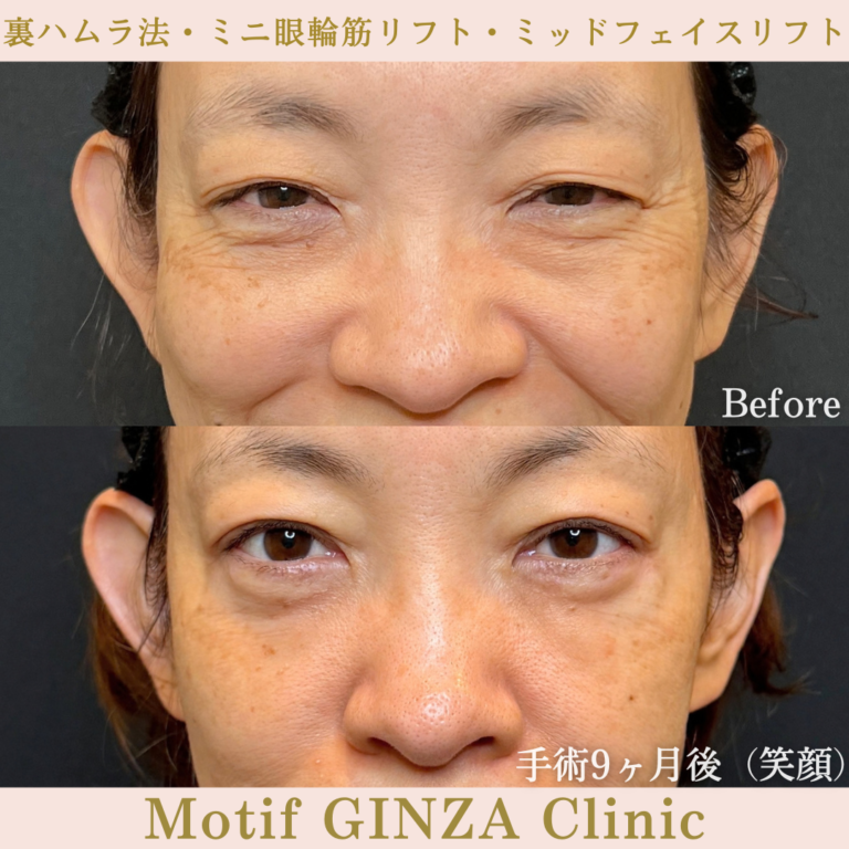 裏ハムラ法・ミニ眼輪筋リフト・ミッドフェイスリフト（手術9か月）の写真2