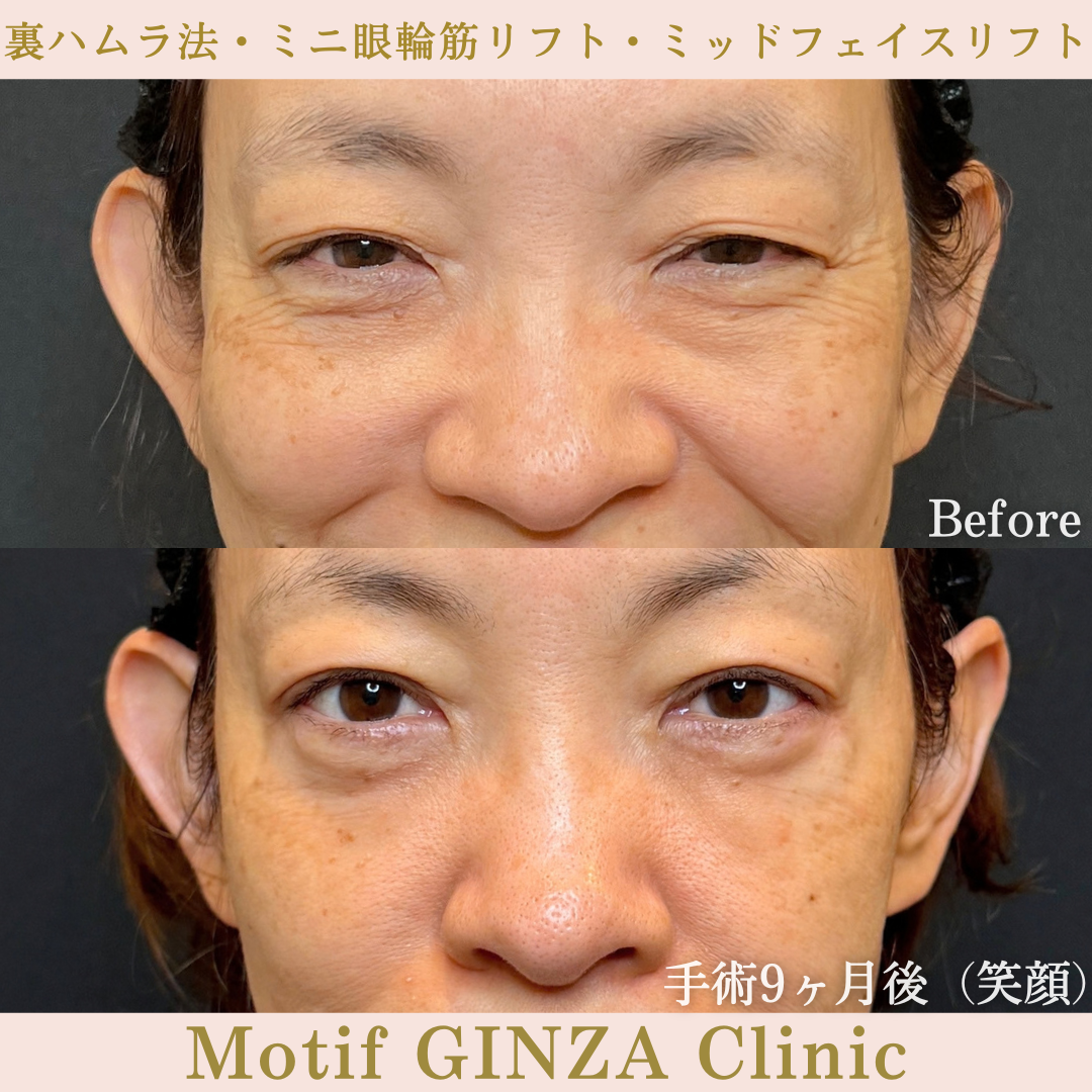 裏ハムラ法・ミニ眼輪筋リフト・ミッドフェイスリフト(手術9か月)の写真2