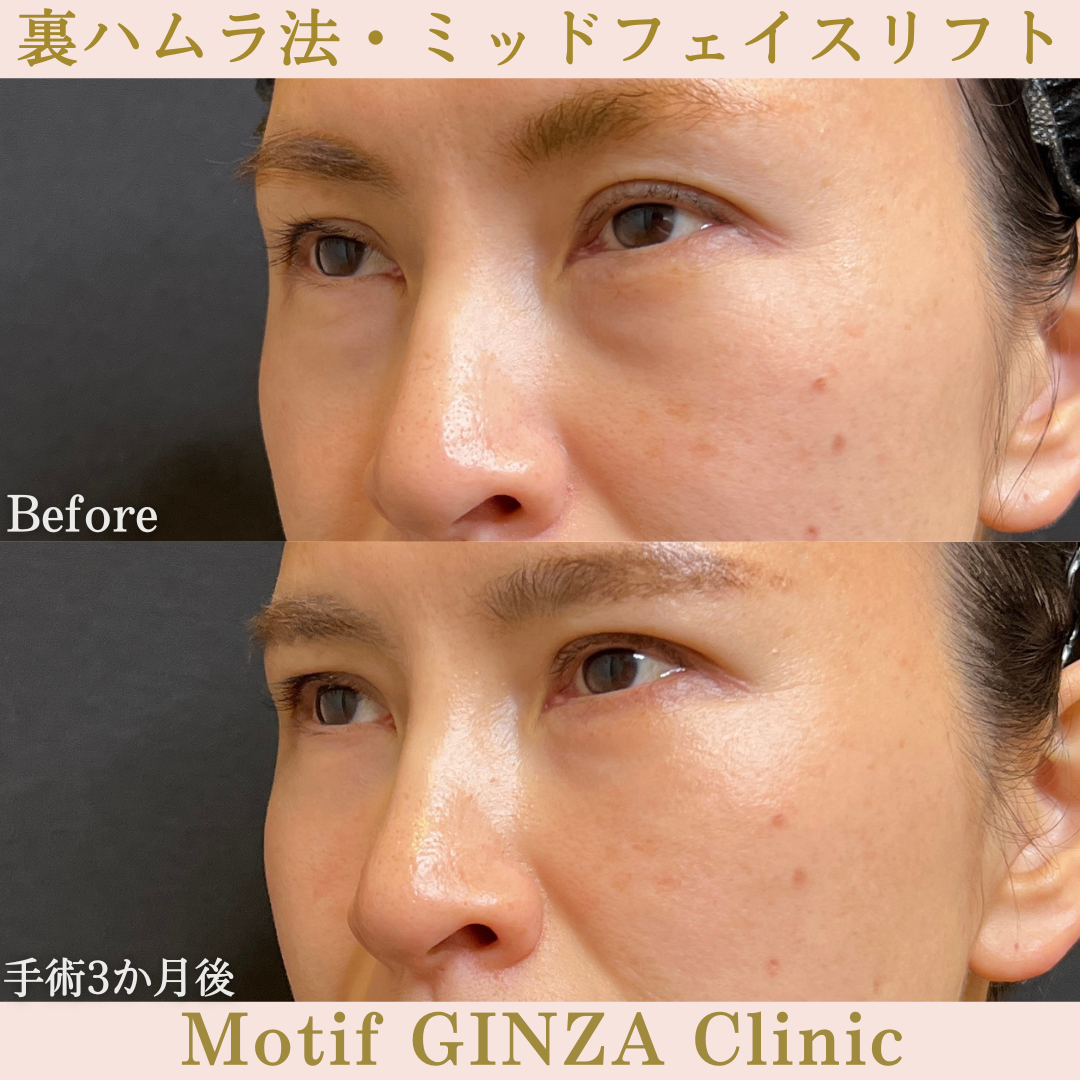 裏ハムラ法・ミッドフェイスリフト（手術１年）の写真4