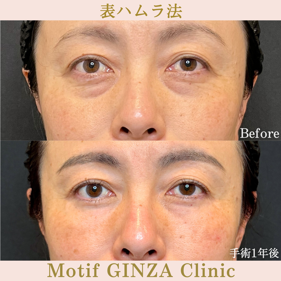 切開式下眼瞼たるみ取り（手術1年）の写真