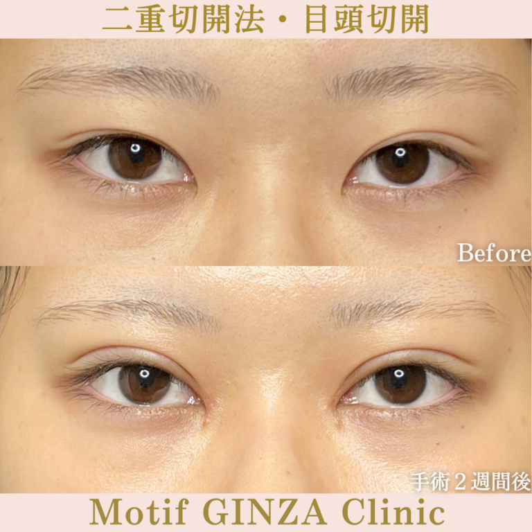 二重切開法・目頭切開（手術３か月）の写真3