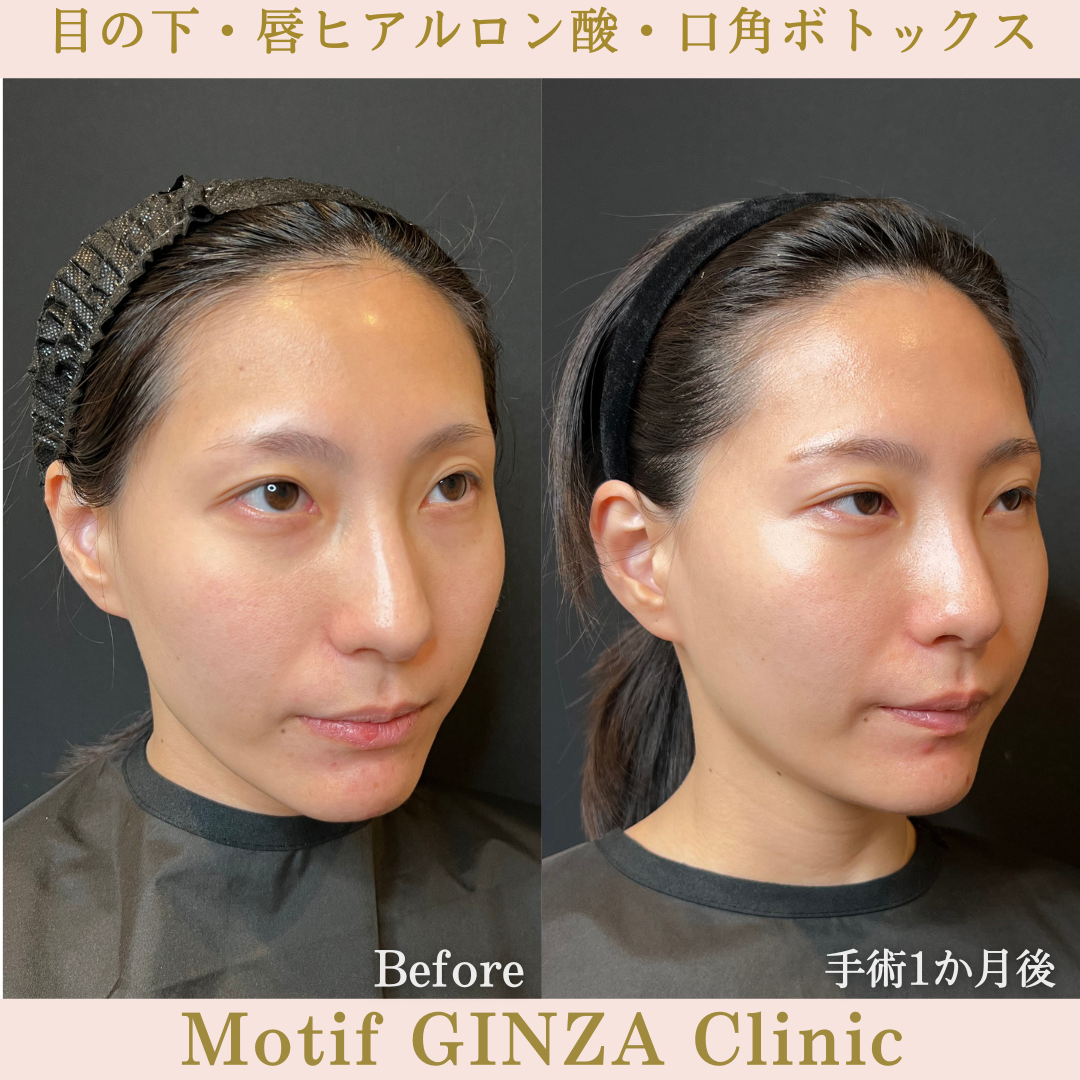 目の下・唇ヒアルロン酸・口角ボトックス（手術１か月）の写真2