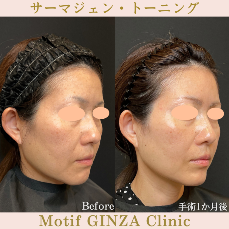 サーマジェン・トーニング(手術1か月)の写真2