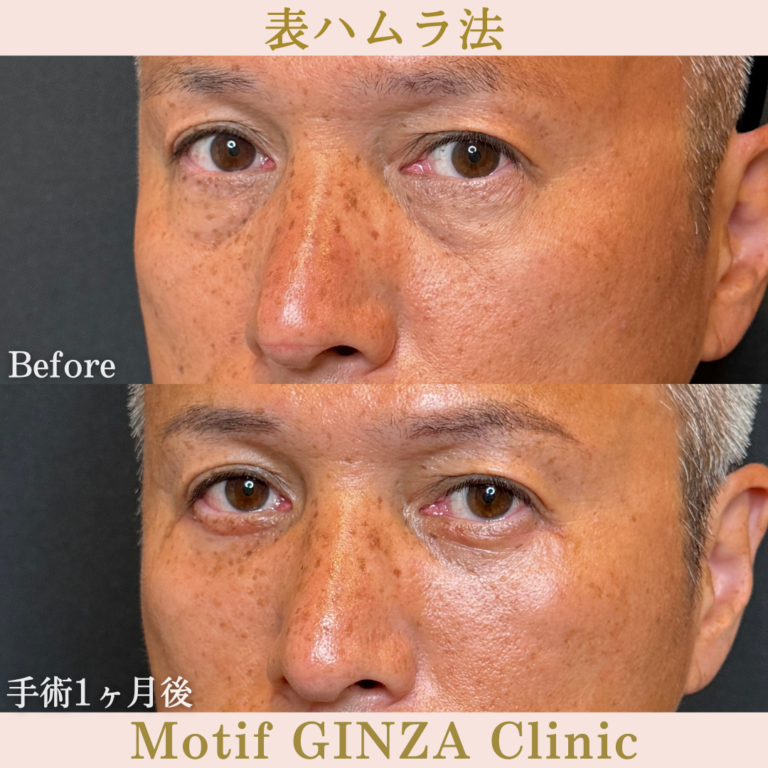 表ハムラ法（手術1か月）の写真2