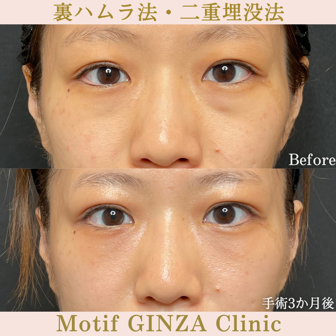 裏ハムラ法・二重埋没法（手術３か月）の写真