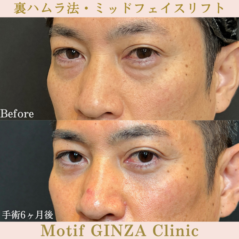 裏ハムラ法・ミッドフェイスリフト(手術6か月)の写真2