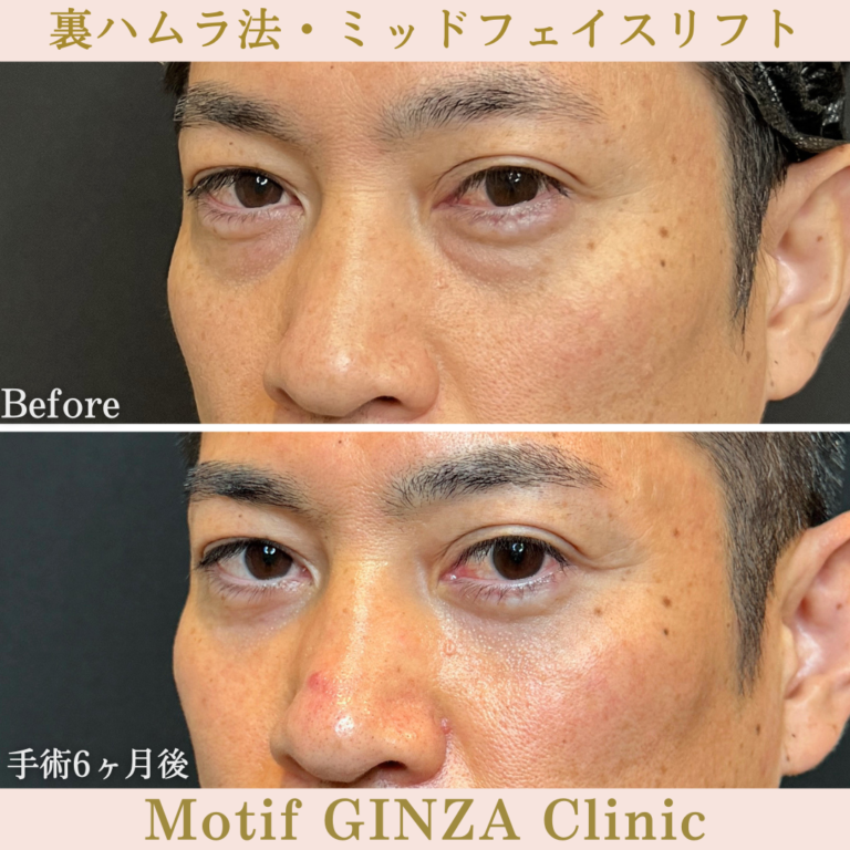 裏ハムラ法・ミッドフェイスリフト（手術6か月）の写真2