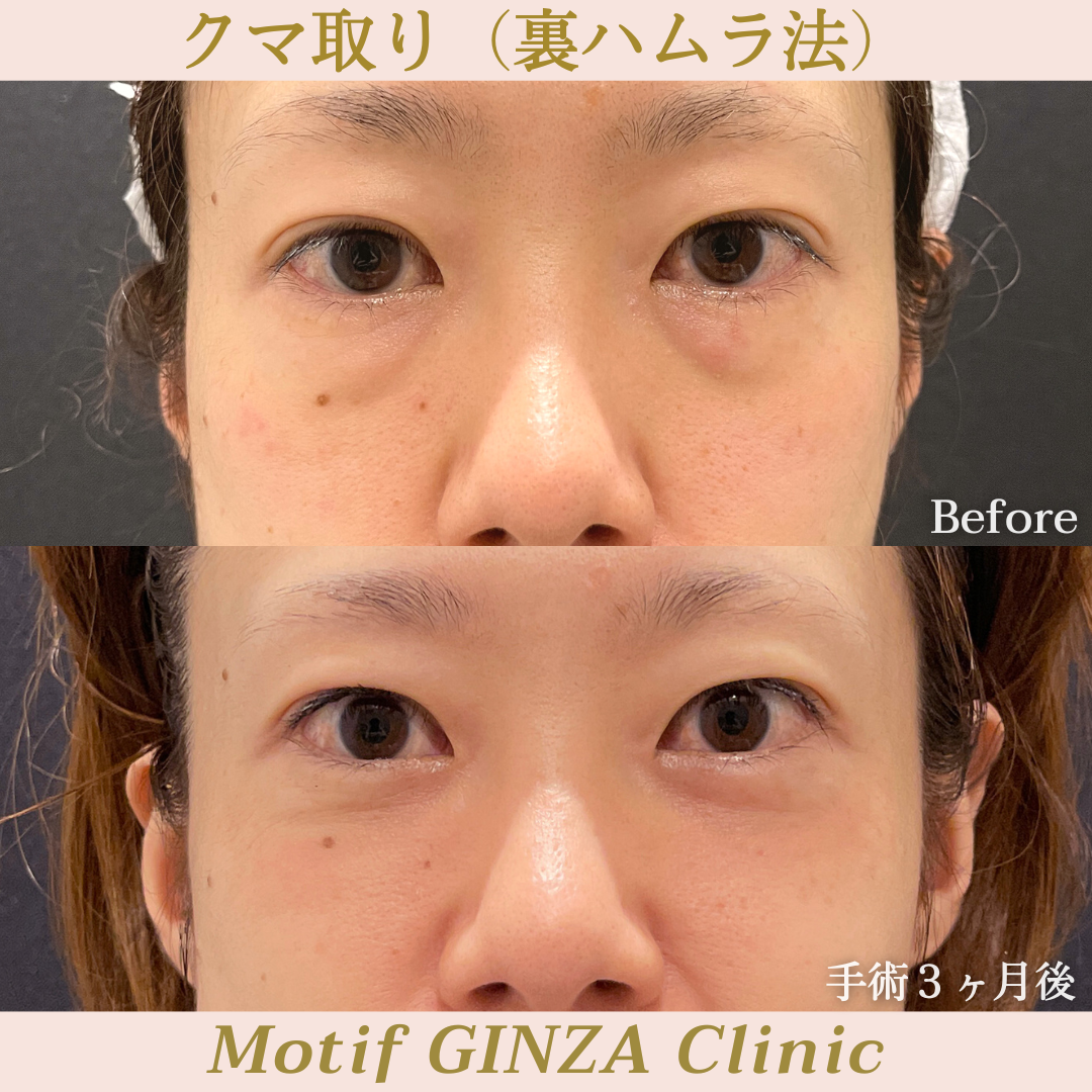 裏ハムラ法（手術３ヶ月）の写真