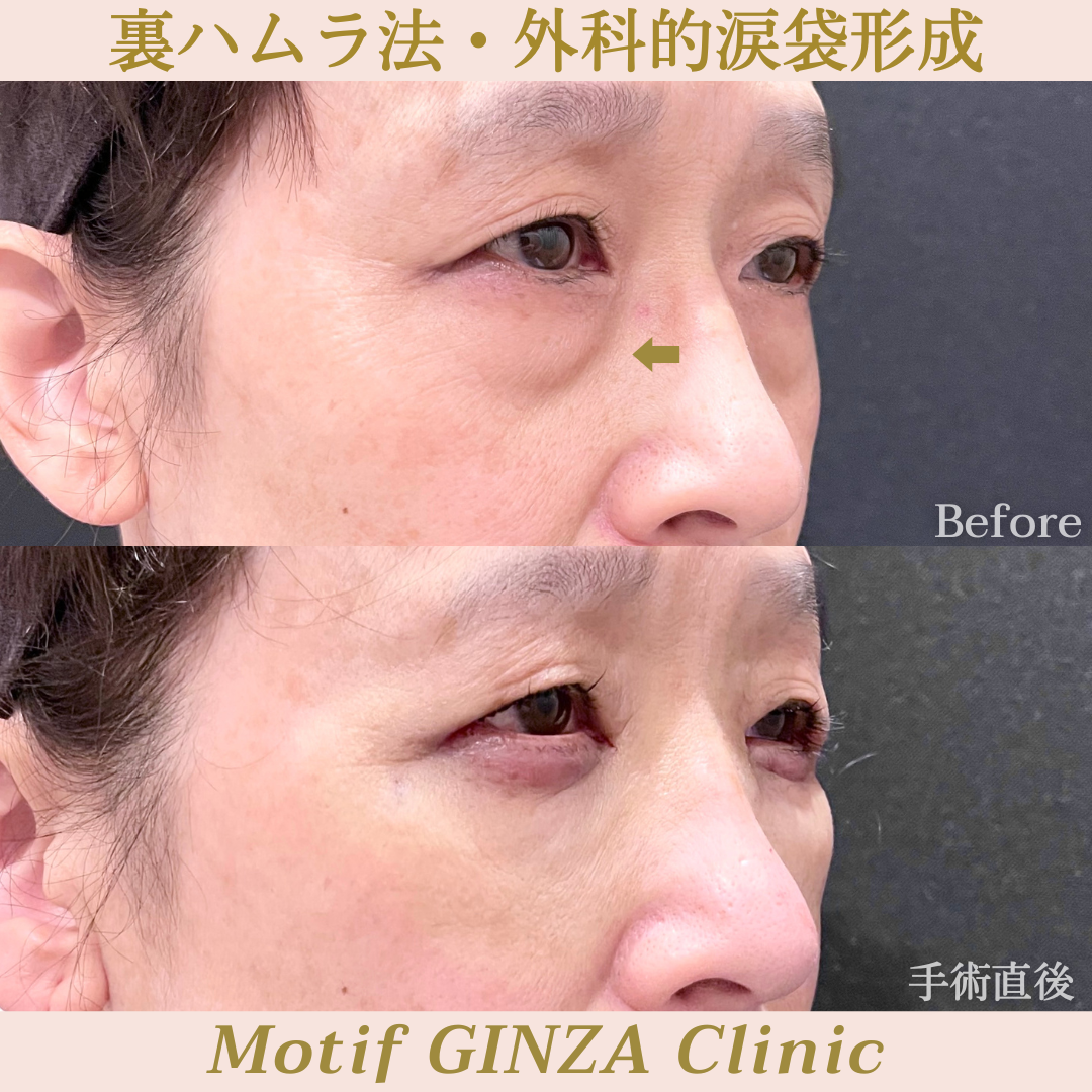 裏ハムラ法・外科的涙袋形成(手術1ヶ月)の写真6