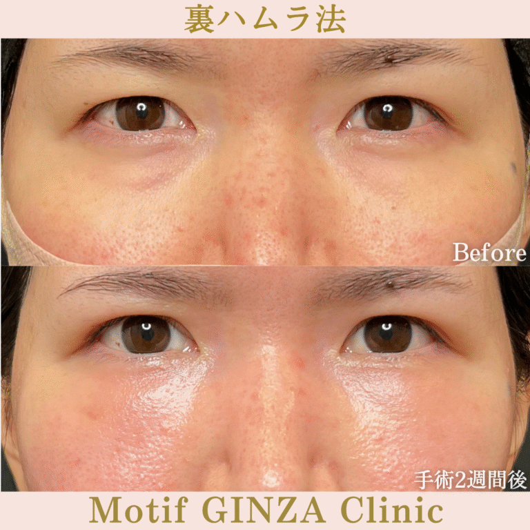 裏ハムラ法（手術３か月）の写真5
