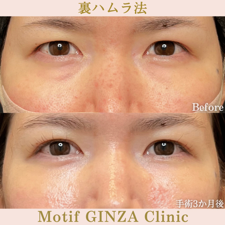 裏ハムラ法(手術3か月)