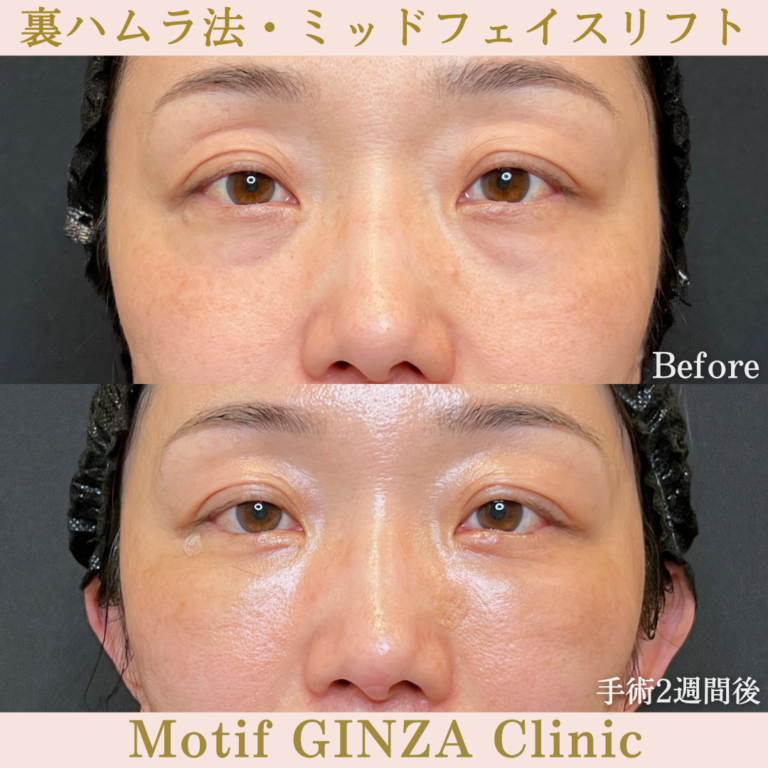 裏ハムラ法・ミッドフェイスリフト(手術3か月)の写真5