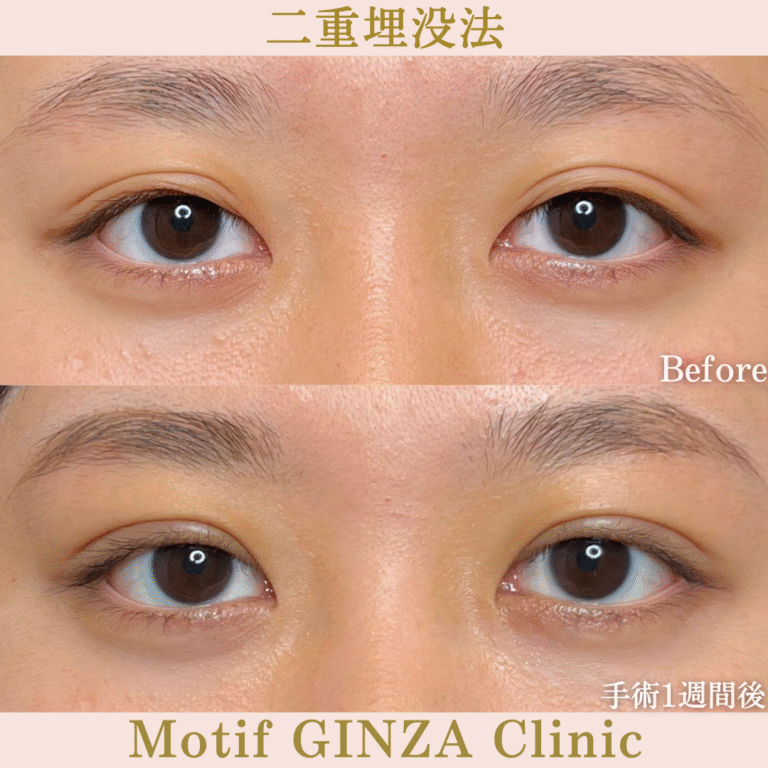 二重埋没法(手術1か月)の写真2