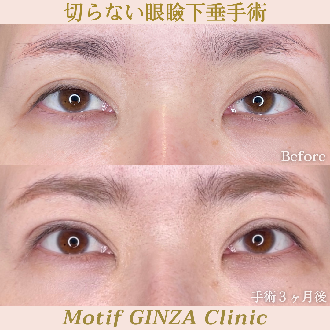 切らない眼瞼下垂手術（手術３ヶ月）の写真
