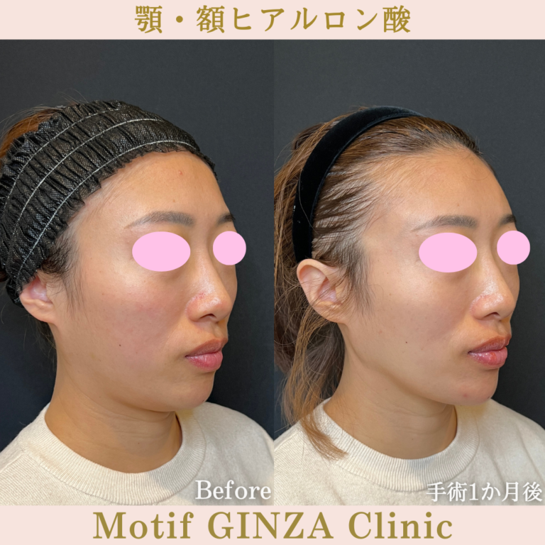 顎・額ヒアルロン酸（手術１か月）の写真2