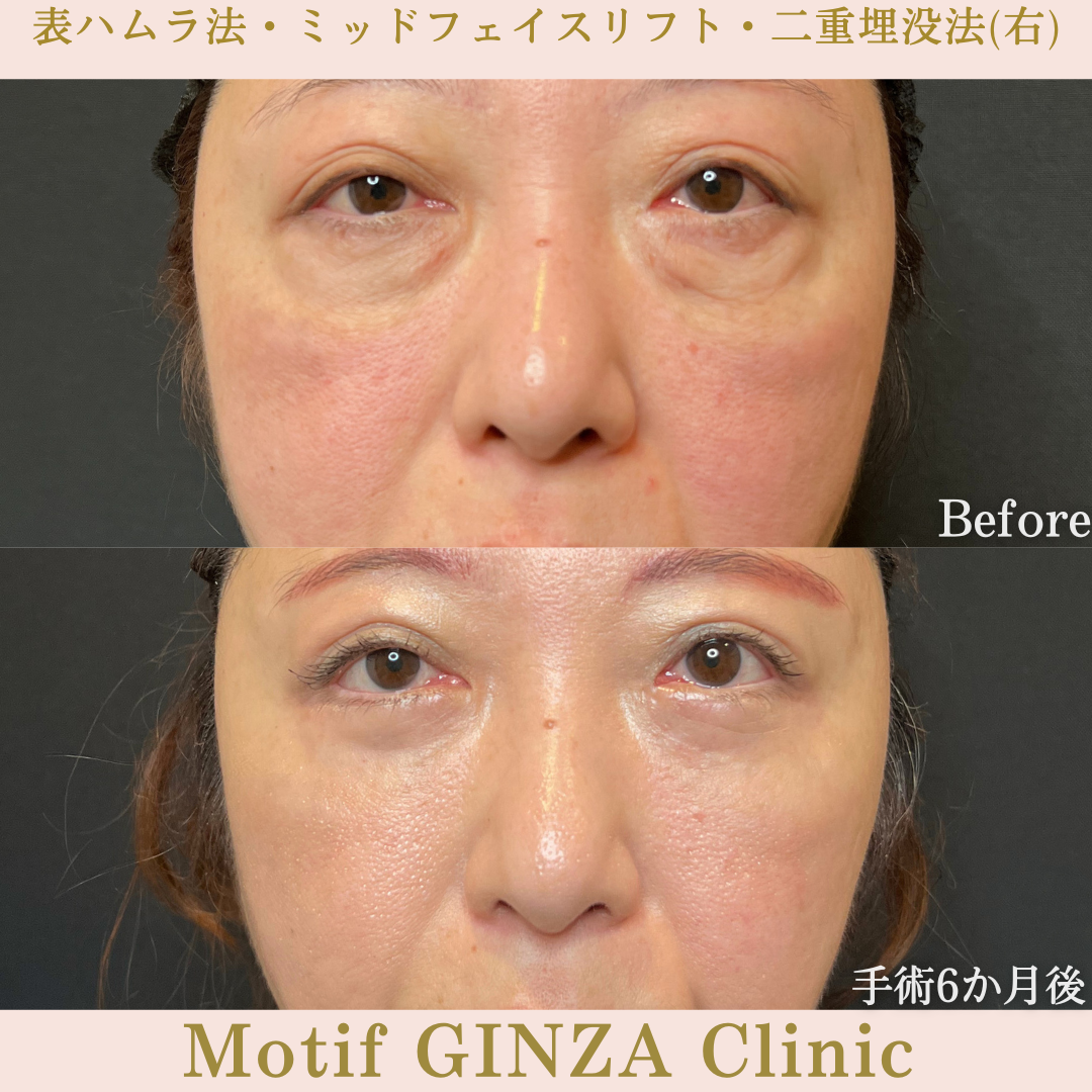 切開式下眼瞼たるみ取り・ミッドフェイスリフト・二重埋没法（手術６か月）の写真