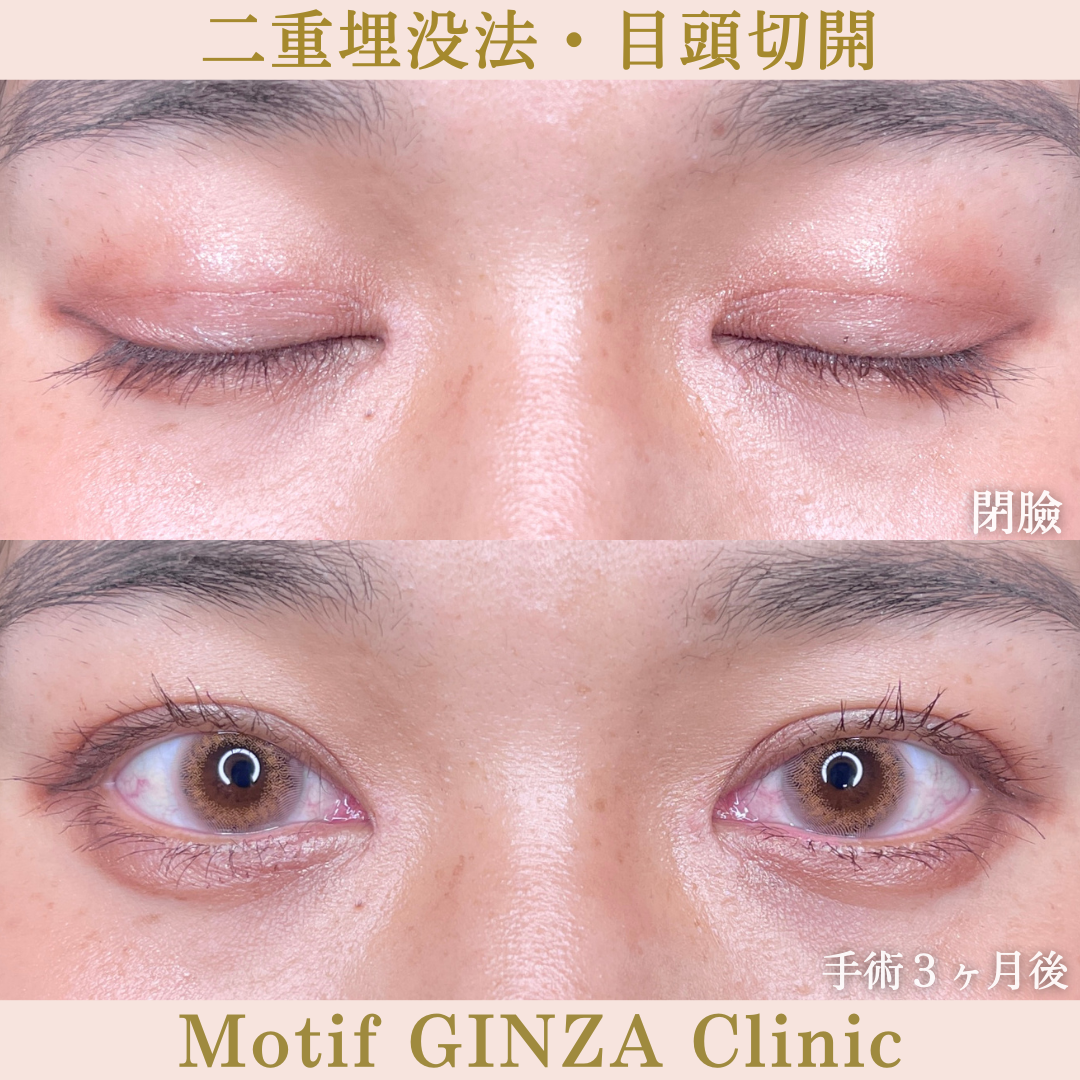 二重埋没法・目頭切開(手術3ヶ月)の写真2
