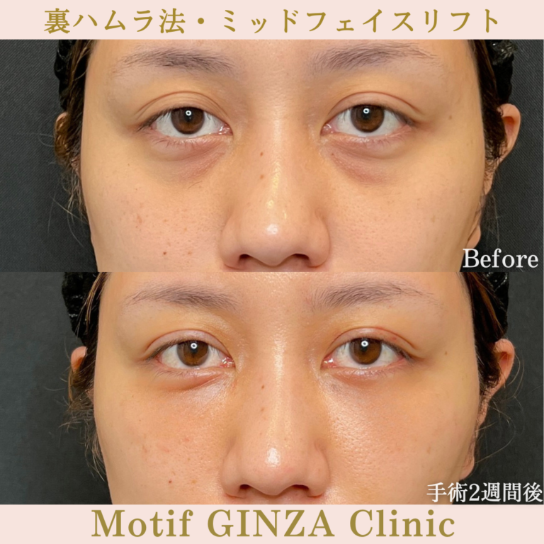 裏ハムラ法・ミッドフェイスリフト(手術5か月)の写真5