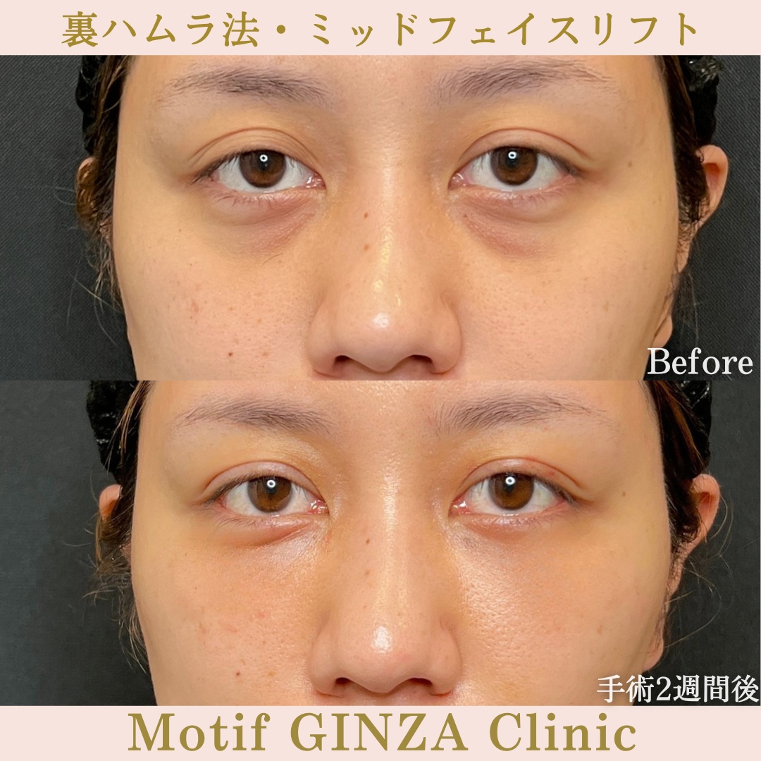 裏ハムラ法・ミッドフェイスリフト(手術5か月)の写真5