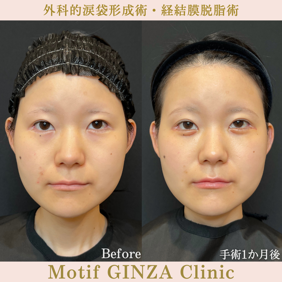 外科的涙袋形成術・経結膜脱脂術（手術３か月）の写真4