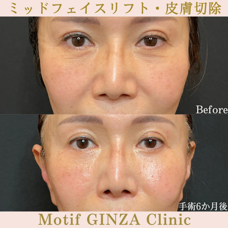 ミッドフェイスリフト・皮膚切除（手術６か月）