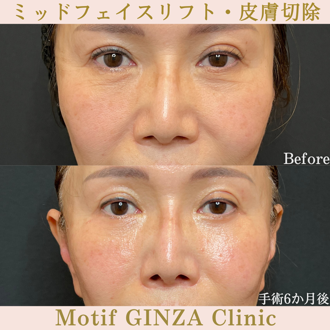 ミッドフェイスリフト・皮膚切除（手術６か月）の写真