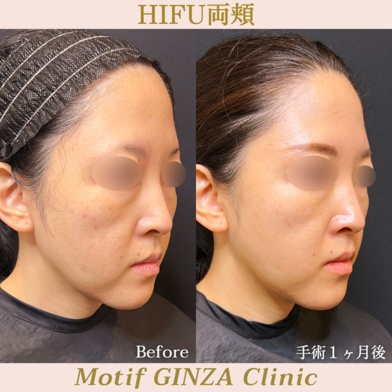 HIFU両頬（手術１ヶ月）の写真2
