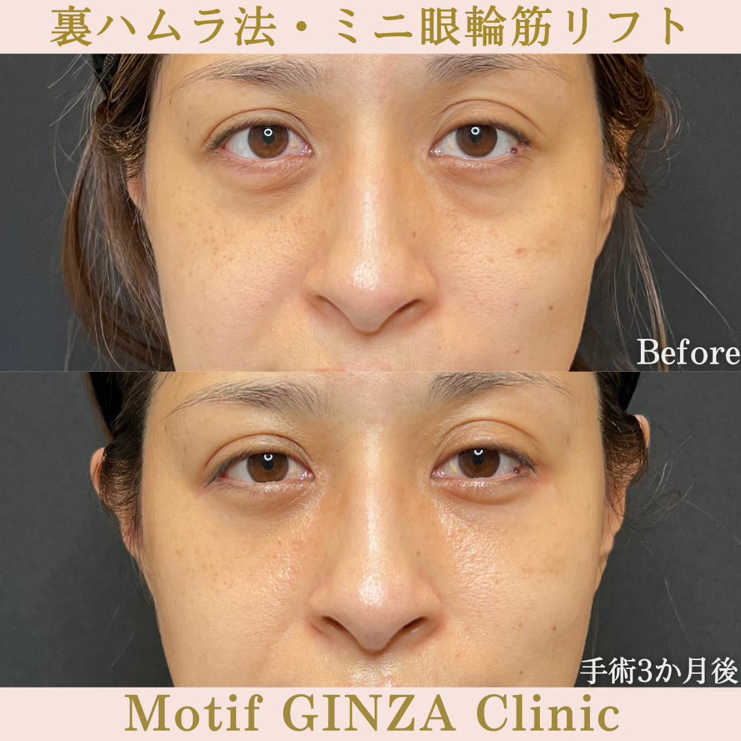 裏ハムラ法・ミニ眼輪筋リフト(手術1年)の写真5