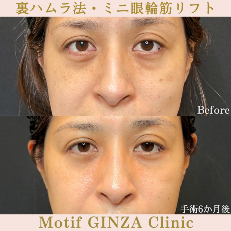 裏ハムラ法・ミニ眼輪筋リフト（手術６か月）