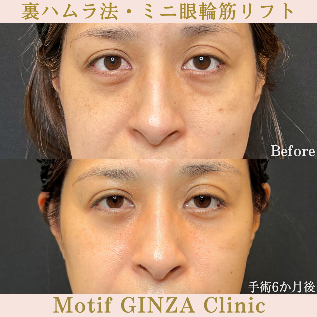 裏ハムラ法・ミニ眼輪筋リフト(手術1年)の写真4