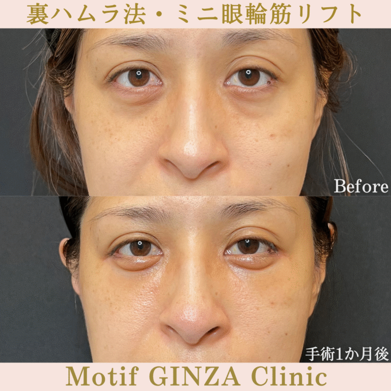 裏ハムラ法・ミニ眼輪筋リフト(手術1か月)