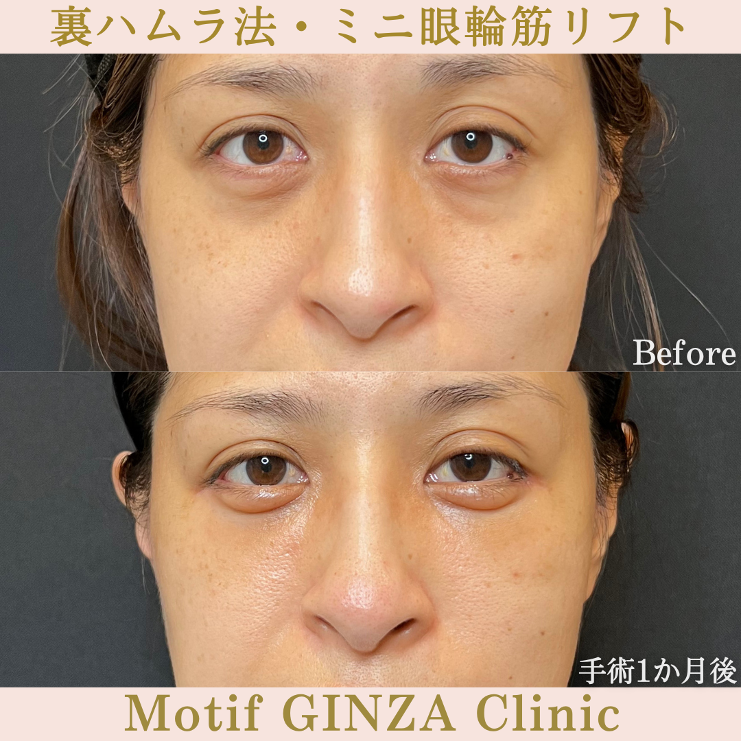 裏ハムラ法・ミニ眼輪筋リフト(手術1年)の写真6