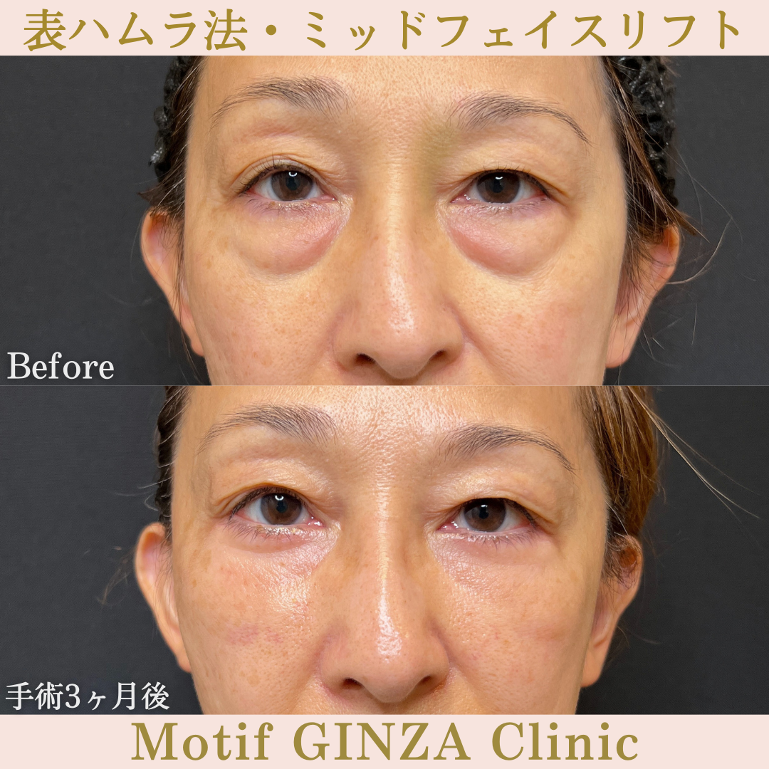切開式下眼瞼たるみ取り・ミッドフェイスリフト（手術３ヶ月）の写真