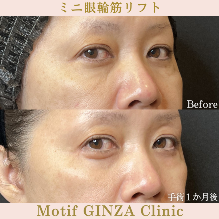 ミニ眼輪筋リフト（手術３か月）の写真4