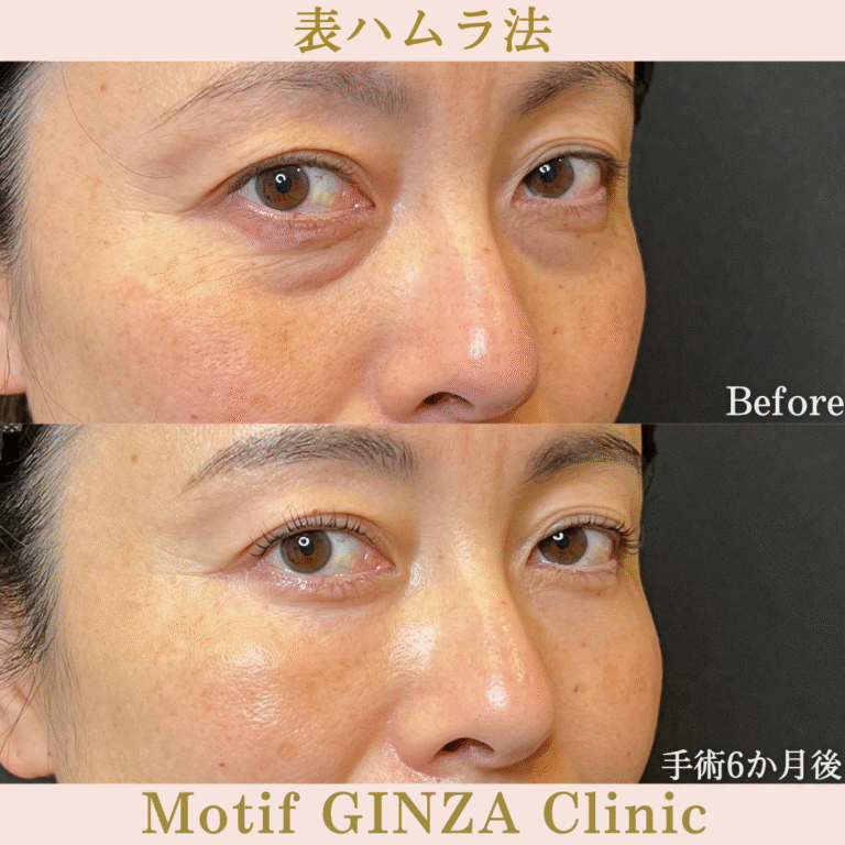 切開式下眼瞼たるみ取り(手術6か月)の写真2