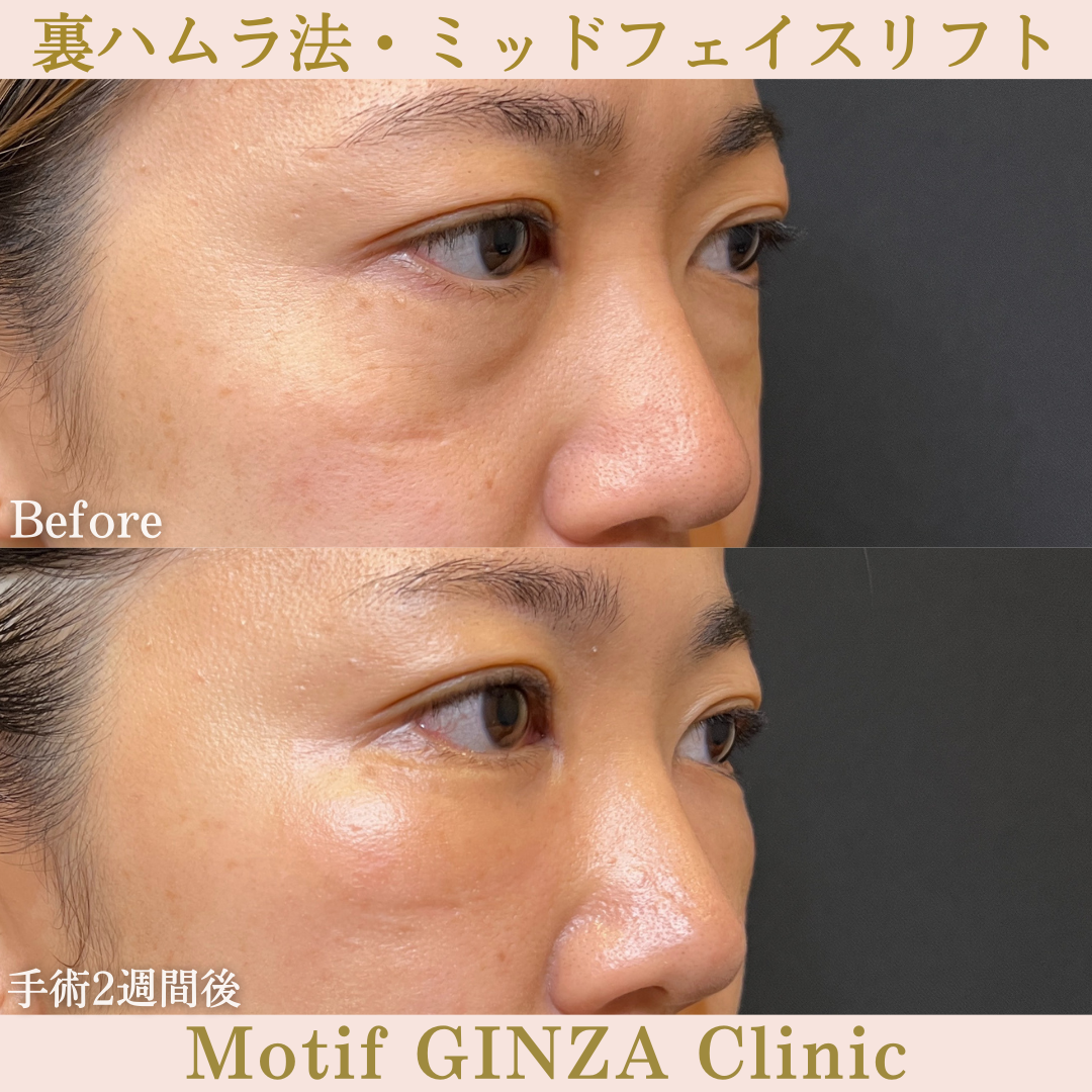 裏ハムラ法・ミッドフェイスリフト（手術１年１ヶ月）の写真6
