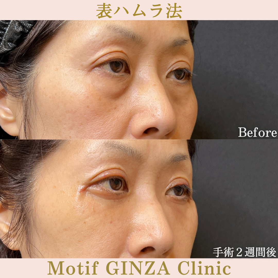切開式下眼瞼たるみ取り(手術3ヶ月)の写真6
