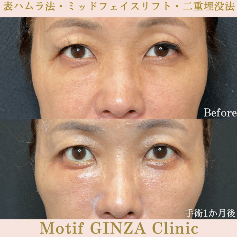 切開式下眼瞼たるみ取り・ミッドフェイスリフト・二重埋没法（手術３か月）の写真2