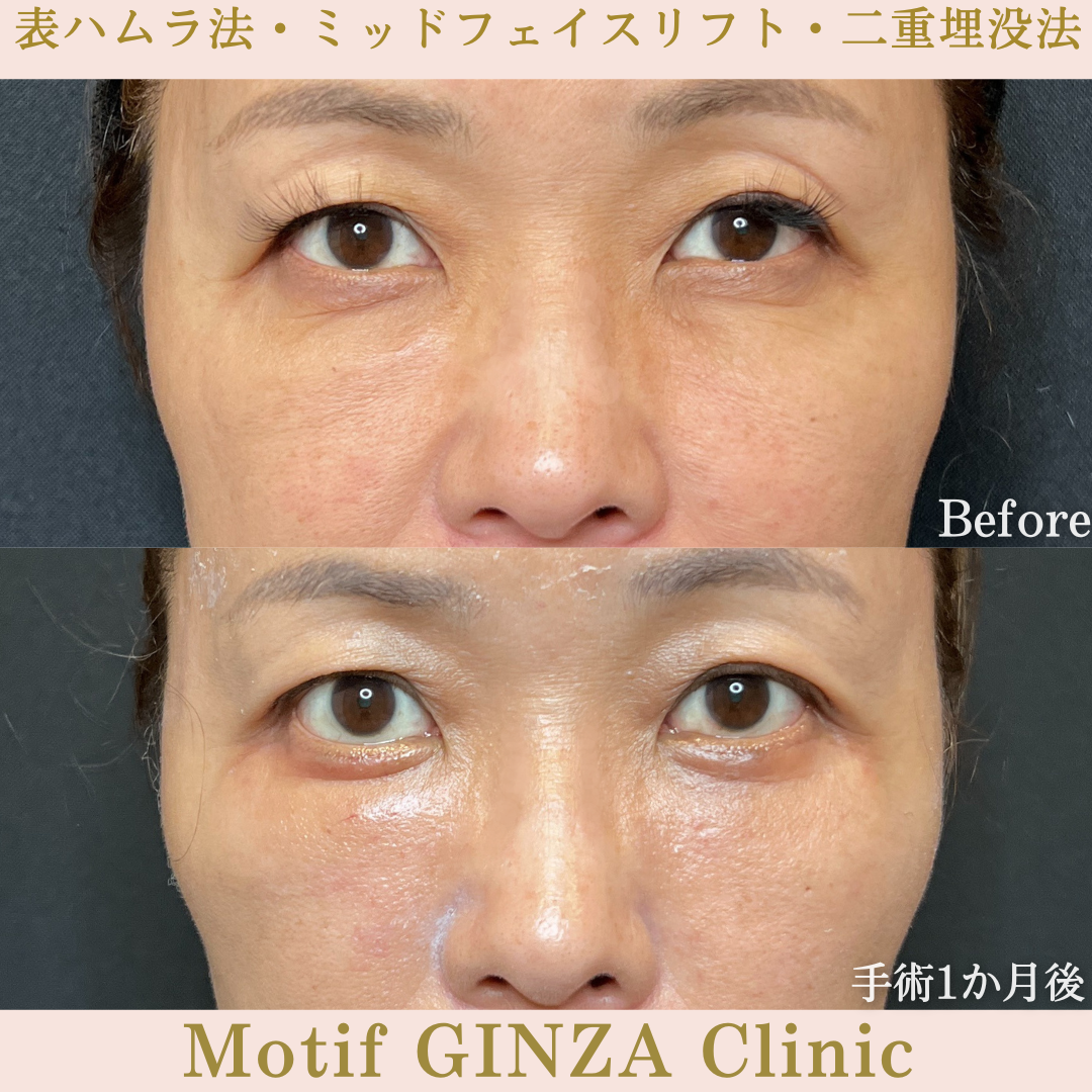 切開式下眼瞼たるみ取り・ミッドフェイスリフト・二重埋没法(手術6か月)の写真3