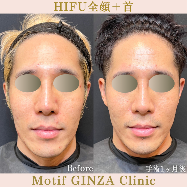 HIFU全顔＋首（手術１ヶ月）